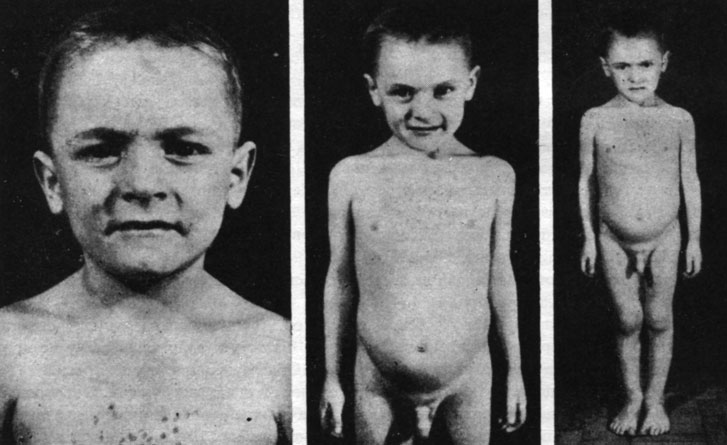 Рис. 13, 14 и 15. - Через 5 месяцев после операции (10.III.1951)