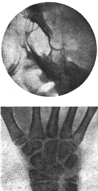 Рис. 64 и 65.- Больной О. А. Рентгенограмма турецкого седла и точек окостенения запястья