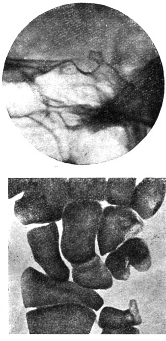 Рис. 92 и 93.- Больной М. С., 15 лет. Рентгенограмма турецкого седла и кисти руки