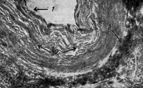 Рис. 133. - Случай 5 (К. Н., 70 лет). Варолиев мост. Артериола с альтеративным эндотелиальным процессом (1) - пикнотические ядра и эндотелиальные веретенообразные клетки в начале десквамации - внутристеночный фиброзный процесс (2); умеренная околососудистая лимфоцитарная реакция (3). Микрофото. Ван-Гизон. Ок. 10; об. 7