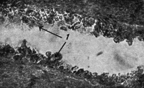 Рис. 137. - Случай 11 (Ф. Ж., 80 лет). Верхняя лобная извилина. Венула с выраженным альтеративным процессом эндотелия - эндотелиальные клетки слущены и склеены с красными кровяными тельцами, образуя негомогенное гиалиновое прирастающее к сосудистым стенкам вещество (1). Микрофото. Ван-Гизон. Ок. 10; об. 7