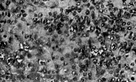 Рис. 163.- Гипофиз крысы с удаленной шишковидной железой (базофилия и ядерное перерождение эозинофильных клеток)