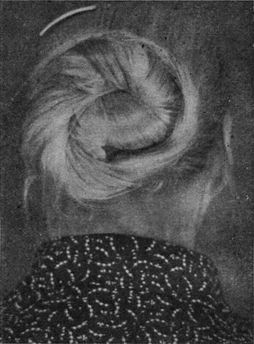Рис. 210. - Волосы больной В. В., 93 лет, после 12-месячного лечения новокаином